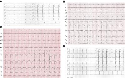 Pheochromocytoma Mimicking Acute Coronary Syndrome: A Case Report